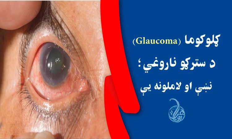 ګلوکوما (Glaucoma) د سترګو ناروغي؛ نښې او لاملونه يې 